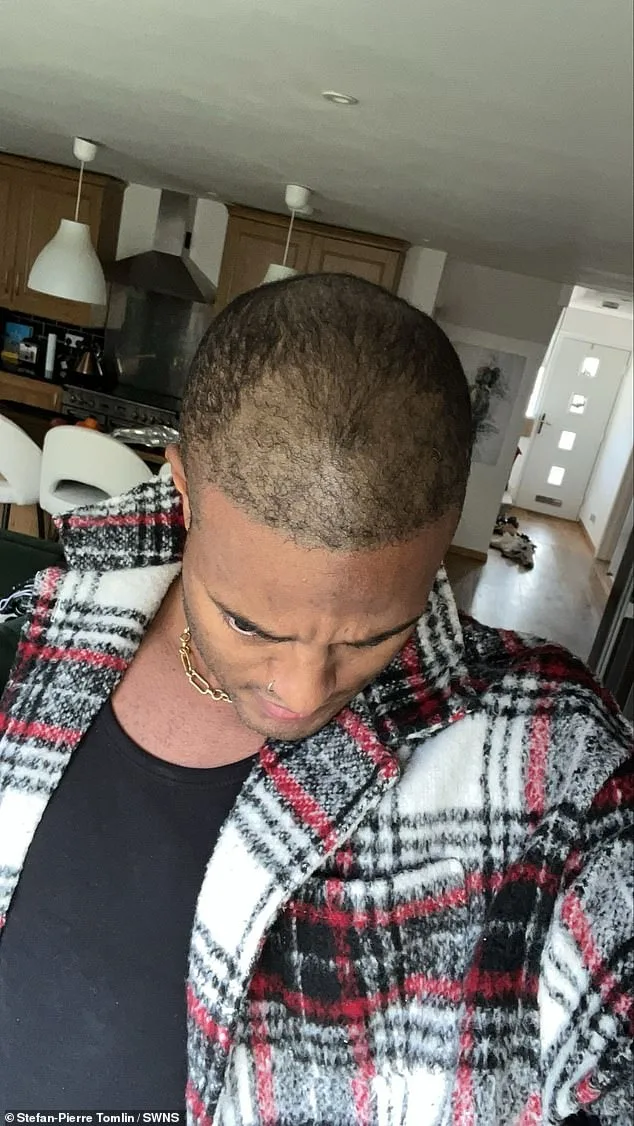 From Lies to Liberation: A Model's Decade-Long Battle with Baldness and a £5,000 Hair Transplant