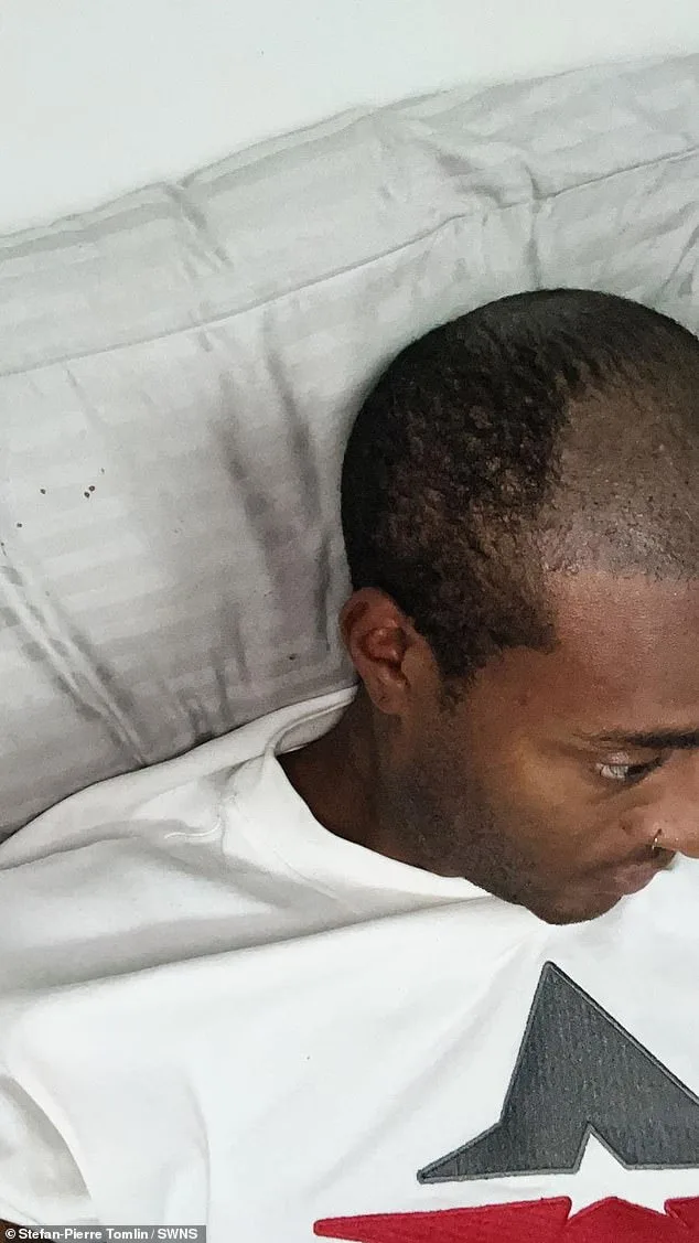 From Lies to Liberation: A Model's Decade-Long Battle with Baldness and a £5,000 Hair Transplant