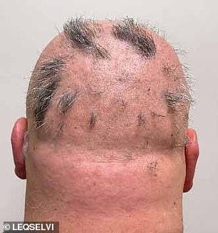 UK Approves Groundbreaking Hair Loss Treatment 'Leqselvi' for Alopecia Areata, Offering New Hope