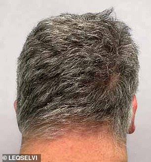 UK Approves Groundbreaking Hair Loss Treatment 'Leqselvi' for Alopecia Areata, Offering New Hope