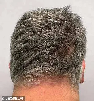 UK Approves Groundbreaking Hair Loss Treatment 'Leqselvi' for Alopecia Areata, Offering New Hope