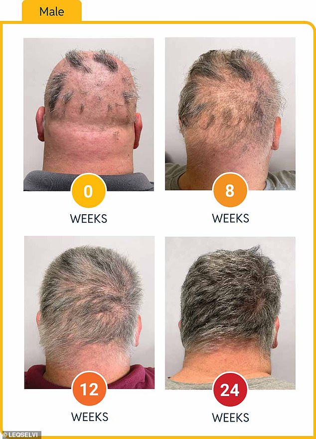 UK Approves Groundbreaking Hair Loss Treatment 'Leqselvi' for Alopecia Areata, Offering New Hope