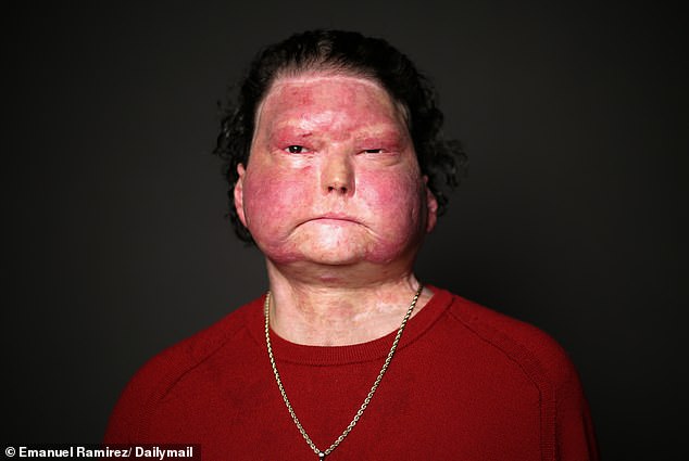 Sleep-Deprived Driver Survives Devastating Crash with 80% Burns