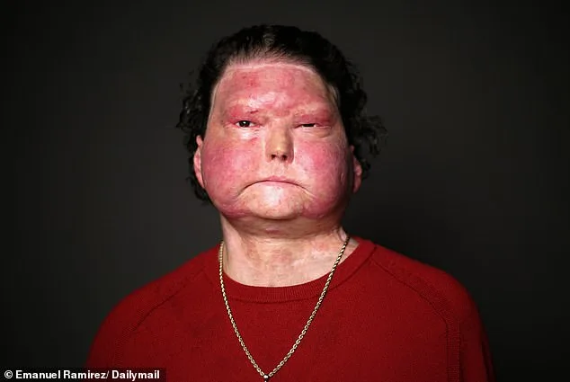 Sleep-Deprived Driver Survives Devastating Crash with 80% Burns
