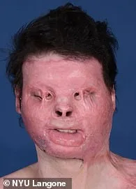 Sleep-Deprived Driver Survives Devastating Crash with 80% Burns