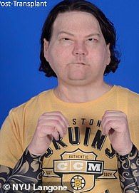 Sleep-Deprived Driver Survives Devastating Crash with 80% Burns