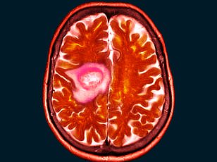 From Blurred Vision to Brain Tumor: How Hormonal Contraceptives May Be Linked to Shelley Whittaker's Rare Diagnosis