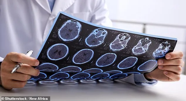 MS Cases in England More Than Double Over 30 Years, Study Links Lifestyle Factors to Higher Mortality Risk