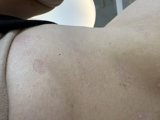Shannon Higham's 14-Year Battle with Psoriasis: Living with Pain and Shame