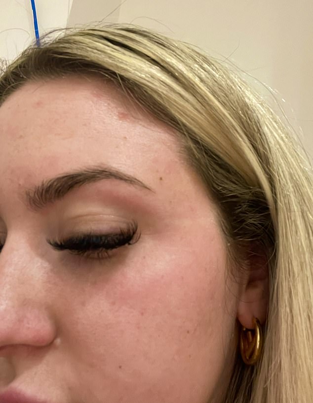 Shannon Higham's 14-Year Battle with Psoriasis: Living with Pain and Shame