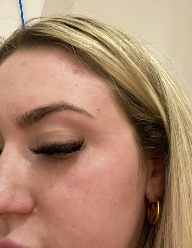 Shannon Higham's 14-Year Battle with Psoriasis: Living with Pain and Shame