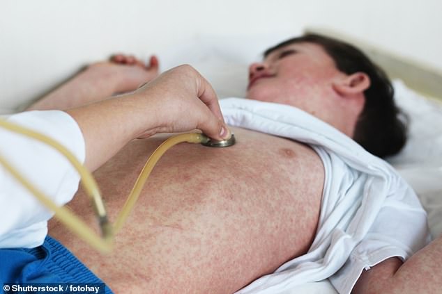 Measles Outbreak Surges in 11 U.S. States, Second-Highest Cases Since Elimination in 2000