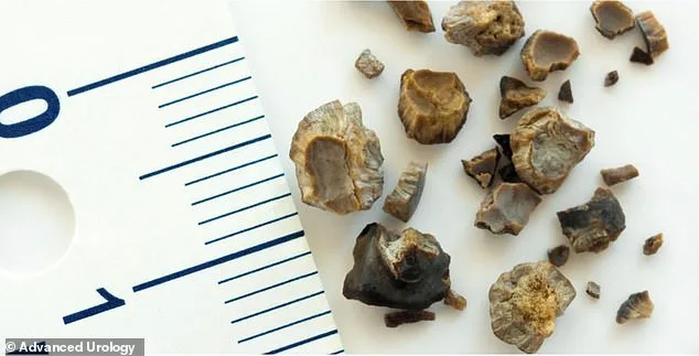 Kidney Stones Surge Among Younger Generations: Rising Rates Alarm Doctors