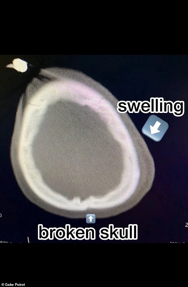 Miraculous Survival: Gabe Poirot's Fight Against Death After a Skateboard Tragedy