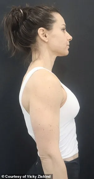 Scar-Free, No-Downtime Breast Augmentation: A New Surgical Breakthrough