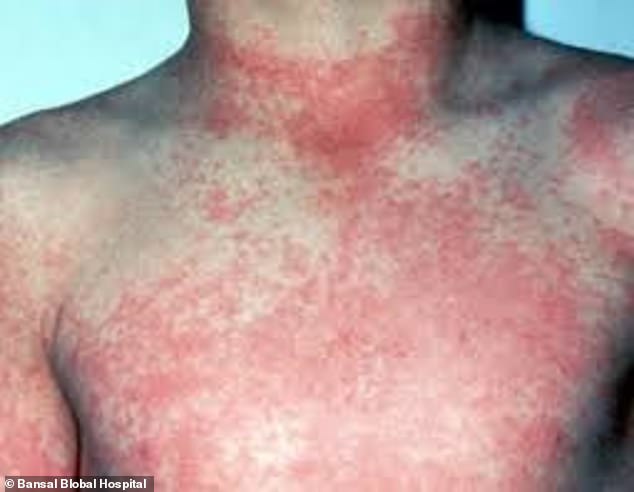 CDC warns travelers as US dengue cases surge 359% in 2024