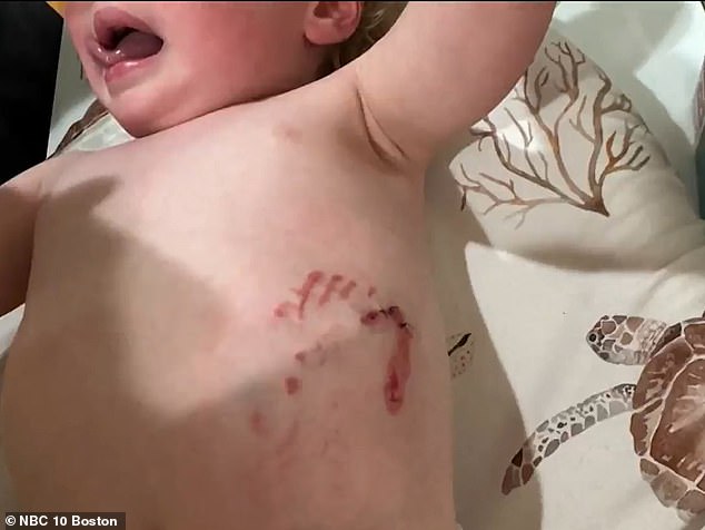 Toddler bitten by raccoon at Massachusetts playground requires rabies shots.