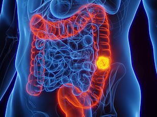 Overweight Babies Face Higher Bowel Cancer Risk, Study Finds