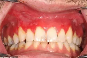 Dental Experts Warn of Painful Gum Disease Linked to Nicotine Pouch Use