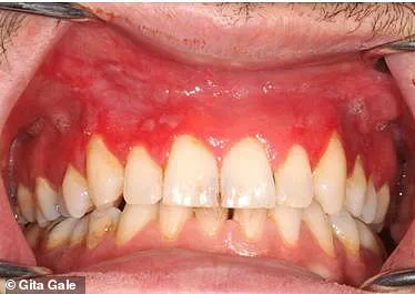 Dental Experts Warn of Painful Gum Disease Linked to Nicotine Pouch Use