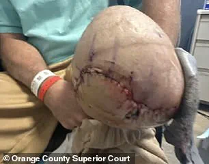 Man Loses Leg After Alleged Surgical Error During Routine Knee Surgery