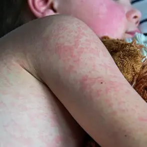 Measles Cases Surpass Previous Year’s Total in Just Three Months