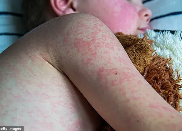 Measles Cases Surpass Previous Year’s Total in Just Three Months