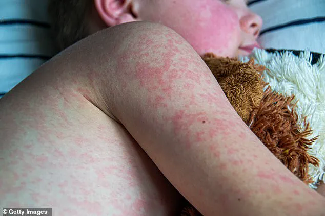 Measles Cases Surpass Previous Year’s Total in Just Three Months