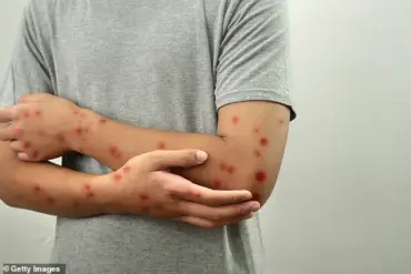 Penn State University Confirms Chickenpox Outbreak, Encourages Vigilance