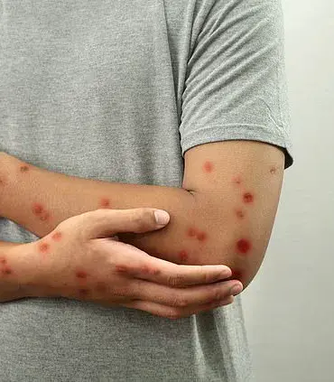 Penn State University Confirms Chickenpox Outbreak, Encourages Vigilance