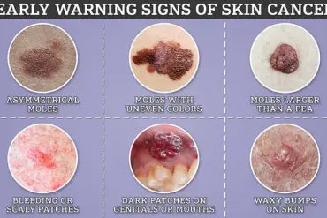 Study Suggests Later Detection of Skin Cancer May Lead to More Severe Stages