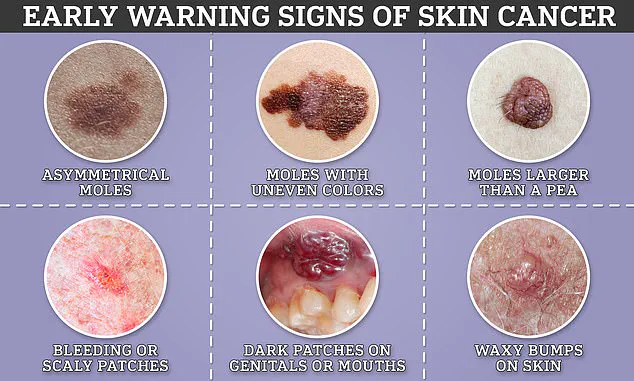 Study Suggests Later Detection of Skin Cancer May Lead to More Severe Stages