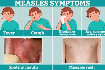 Texas measles outbreak: Public health concerns and expert advisories