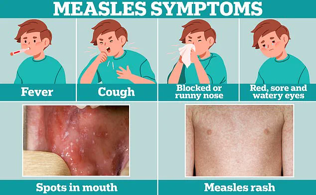 Texas measles outbreak: Public health concerns and expert advisories