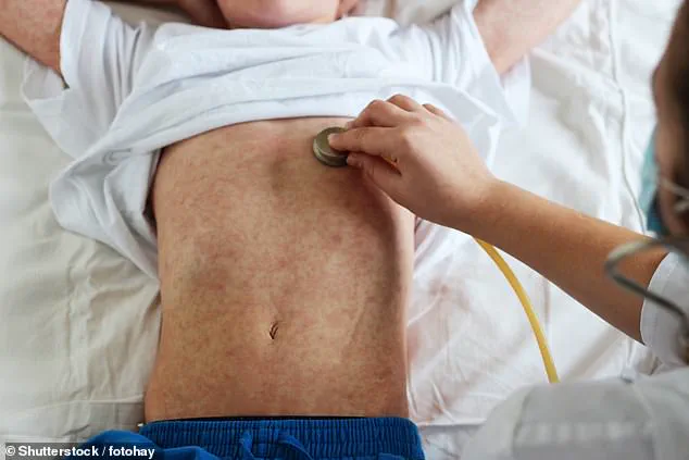 West Texas measles outbreak: A public health concern in a vaccination-skeptical community