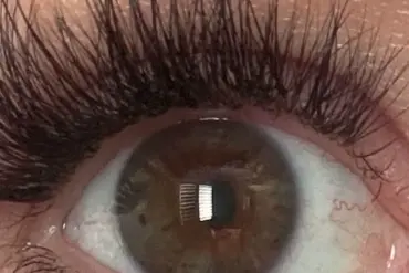 Woman Struck by Lightning Experiences Rare Eye Color Change