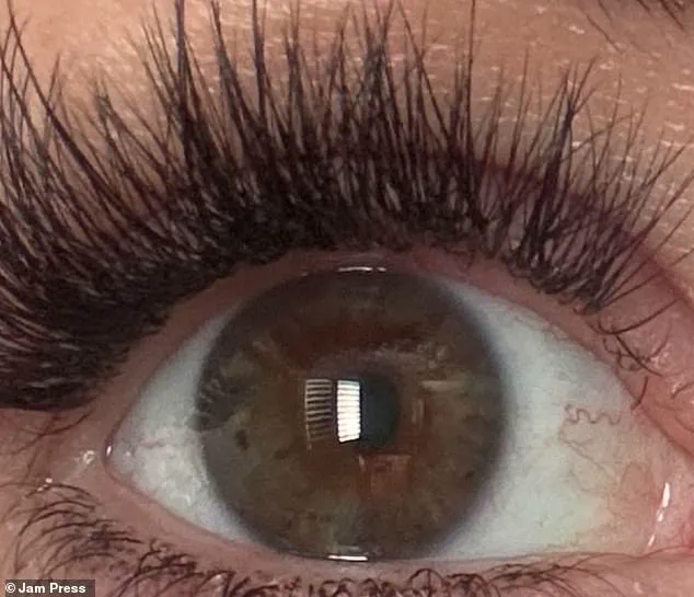 Woman Struck by Lightning Experiences Rare Eye Color Change