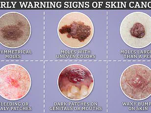 Dermatologist Issues Urgent Warning: Feel Changes in Moles May Indicate Deadly Melanoma
