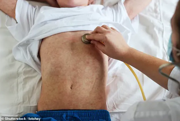 US Faces Worst Measles Outbreak in Over Two Decades with 712 Cases Reported