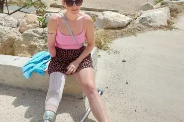 Woman Amputates Hand to Escape 'Suicide Disease' Complex Regional Pain Syndrome