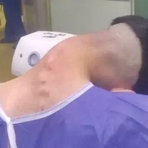 Dropped Head Syndrome: A Rare Consequence of Long-Term Drug Use Revealed in Shocking Images