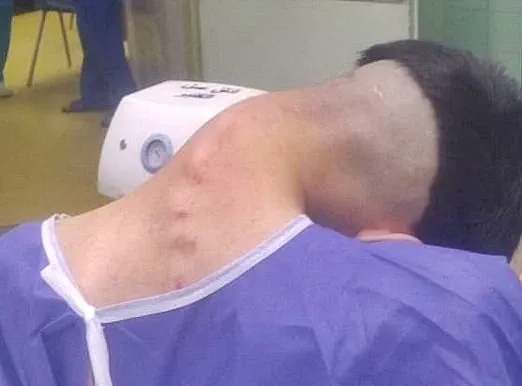 Dropped Head Syndrome: A Rare Consequence of Long-Term Drug Use Revealed in Shocking Images