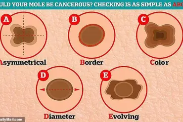 Privileged Access, Hidden Perils: The Melanoma Diagnosis of a Yacht Captain