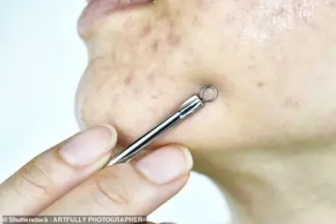 Dermatologists Warn: Popping Pimples Before Big Events Can Lead to Scarring and Costly Treatments