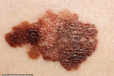 Differentiating Harmless Skin Changes from Potential Dangers: Expert Insights for Public Well-being