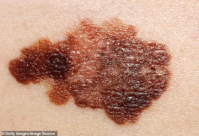 Differentiating Harmless Skin Changes from Potential Dangers: Expert Insights for Public Well-being