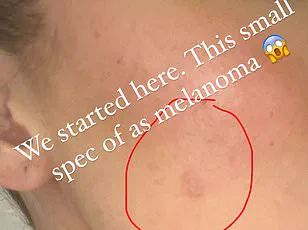 From Wine to Skin Cancer: How an Uncommon Symptom Led to a Deadly Diagnosis