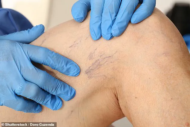 The Growing Concern Over Thread Veins: NHS Coverage and Available Treatments