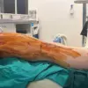 A Painful Path to Perfection: The Grueling Reality of Height-Enhancing Surgery in the UK