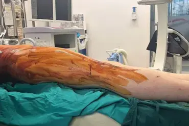 A Painful Path to Perfection: The Grueling Reality of Height-Enhancing Surgery in the UK